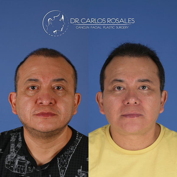 <tc>Deepplane facelift with deep necklift</tc>