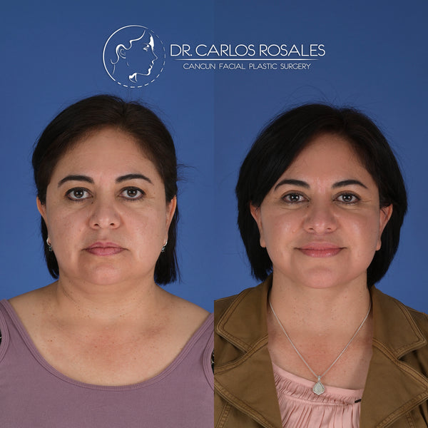 <tc>Deepplane facelift with deep necklift</tc>