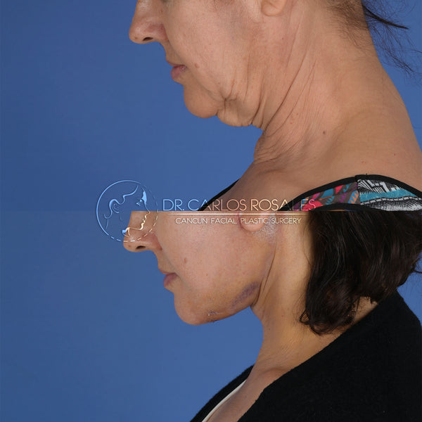 Lifting profundo de Cuello (Solo el cuello)