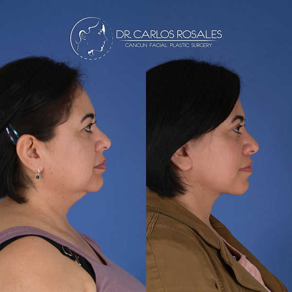 <tc>Deepplane facelift with deep necklift</tc>
