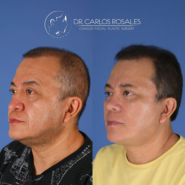 <tc>Deepplane facelift with deep necklift</tc>