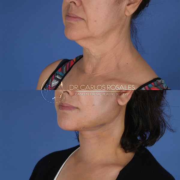 Lifting profundo de Cuello (Solo el cuello)