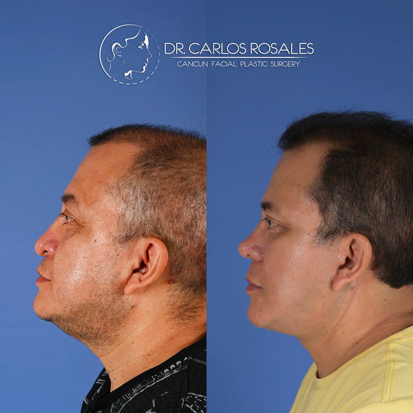 <tc>Deepplane facelift with deep necklift</tc>