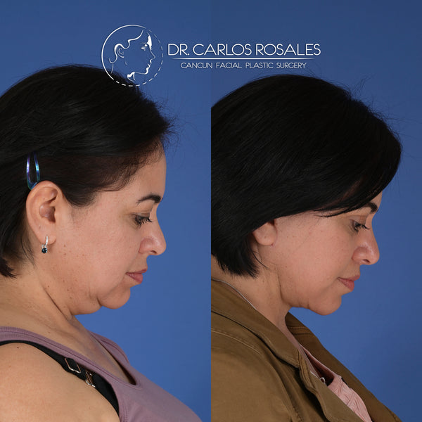 <tc>Deepplane facelift with deep necklift</tc>