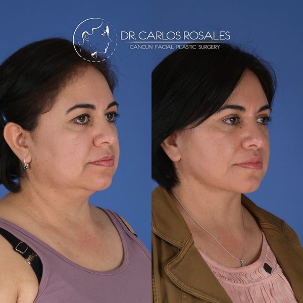 <tc>Deepplane facelift with deep necklift</tc>