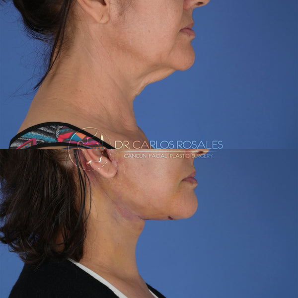 Lifting profundo de Cuello (Solo el cuello)