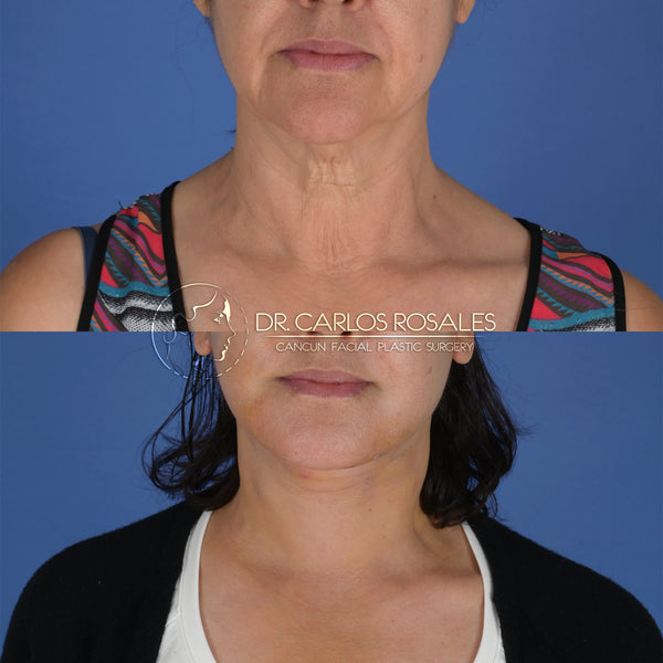 Lifting profundo de Cuello (Solo el cuello)
