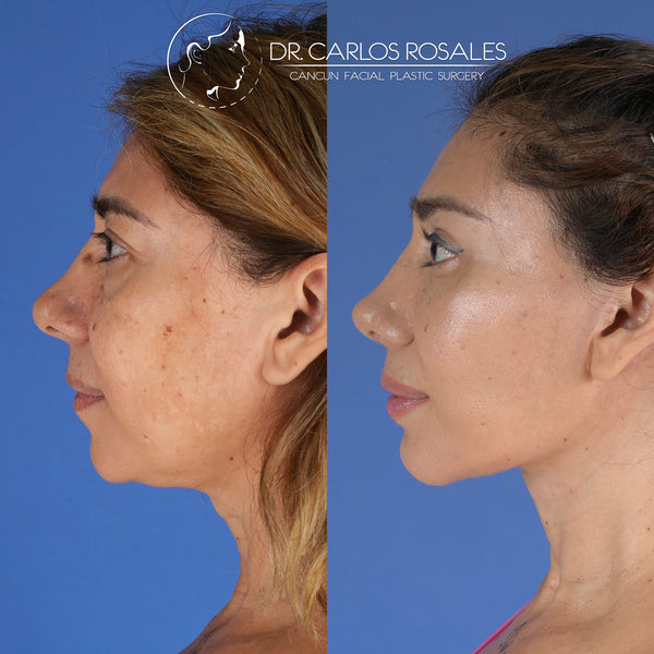 <tc>Deepplane facelift</tc>