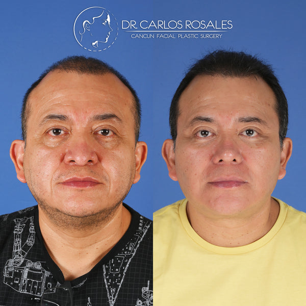 <tc>Deepplane facelift</tc>