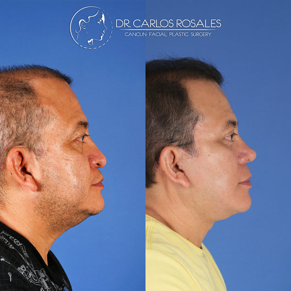 <tc>Deepplane facelift</tc>