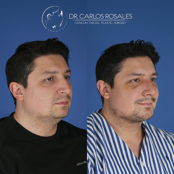 Lifting profundo de Cuello (Solo el cuello)