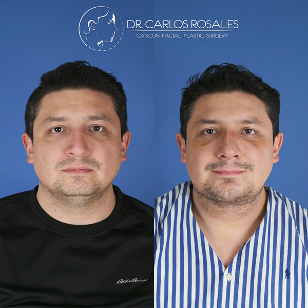 Lifting profundo de Cuello (Solo el cuello)