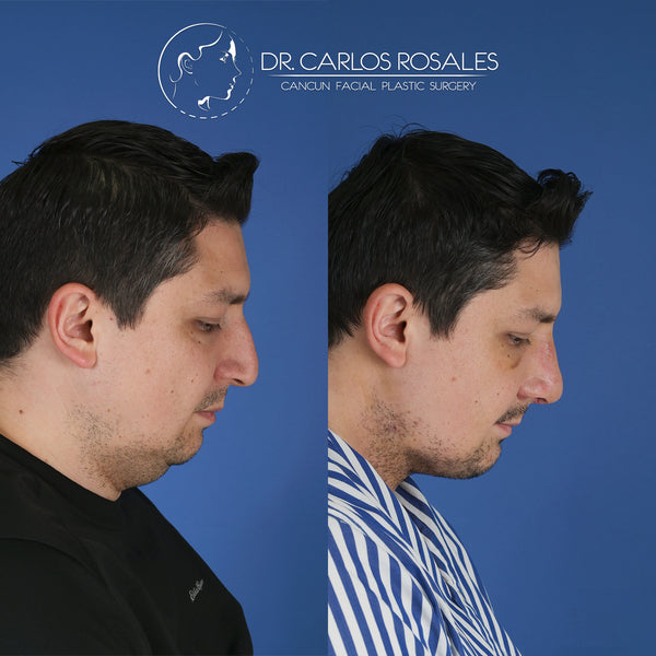 Lifting profundo de Cuello (Solo el cuello)