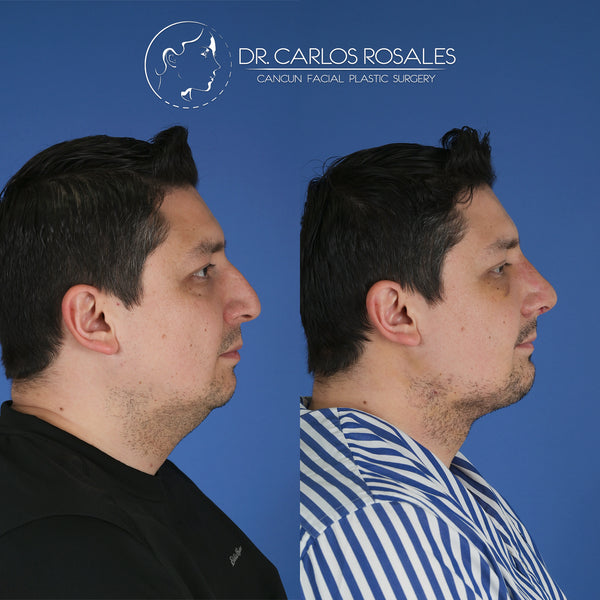 Lifting profundo de Cuello (Solo el cuello)