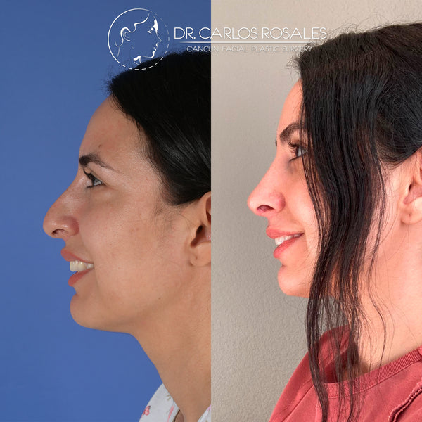 Rinoplastia secundaria