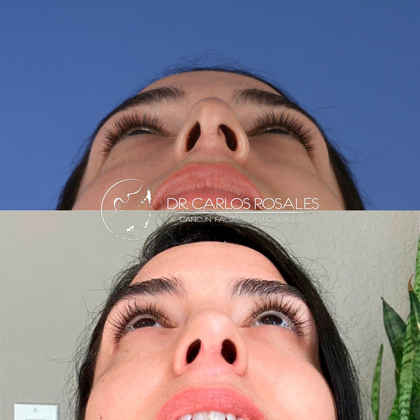 Rinoplastia secundaria