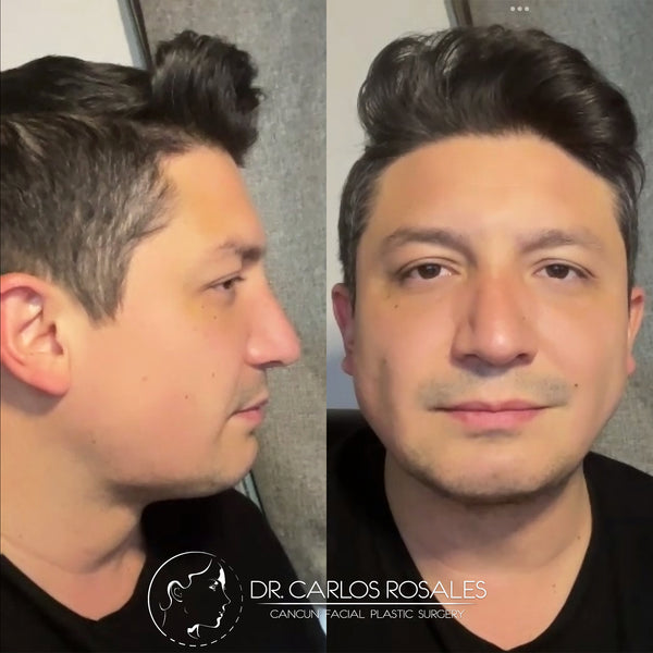 Lifting profundo de Cuello (Solo el cuello)