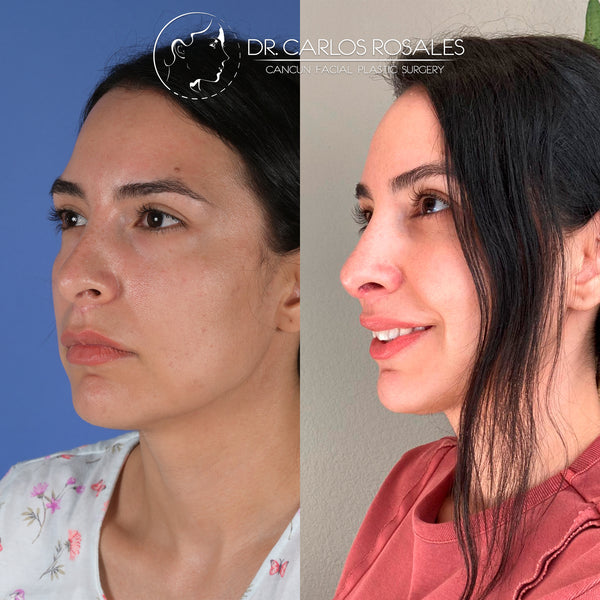 Rinoplastia secundaria