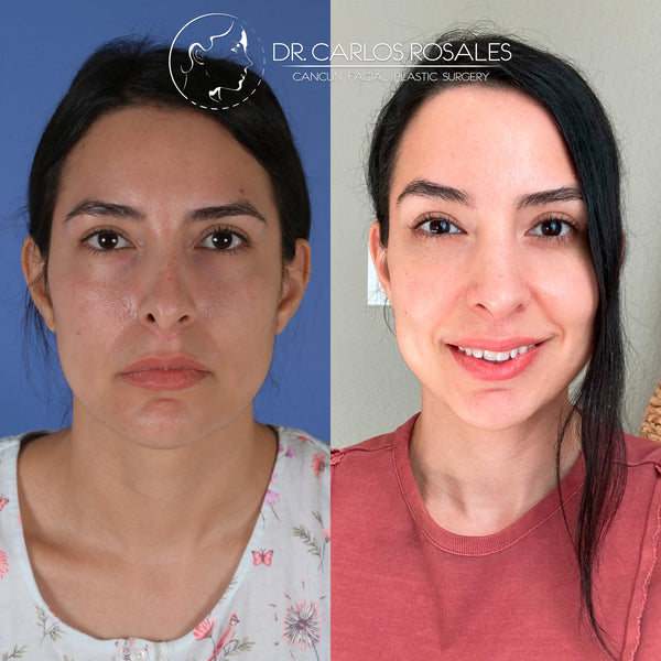 Rinoplastia secundaria