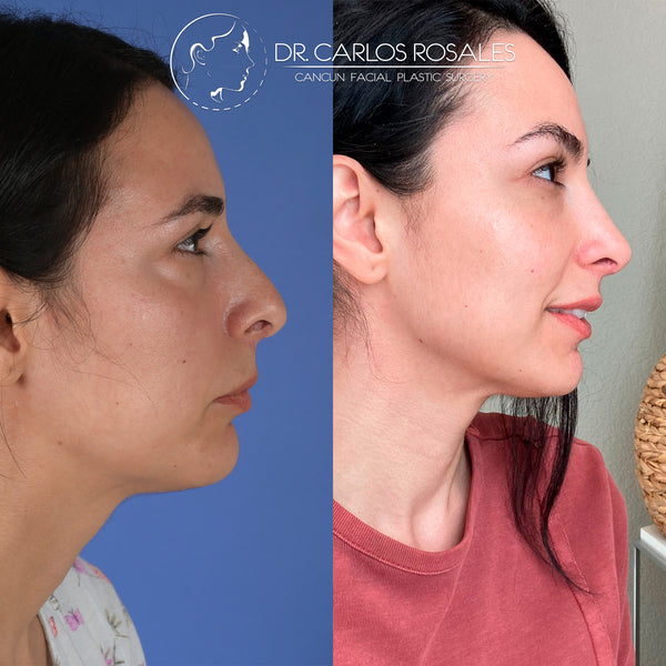 Rinoplastia secundaria