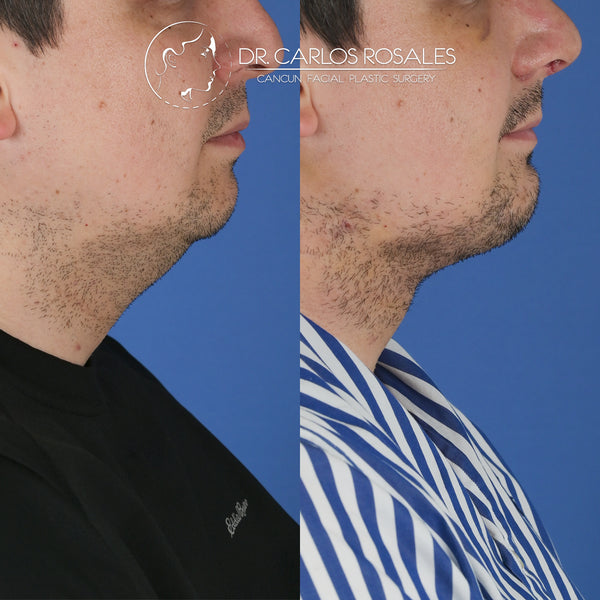 Lifting profundo de Cuello (Solo el cuello)