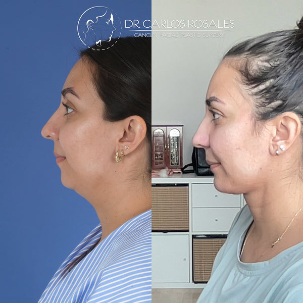 Lifting profundo de Cuello (Solo el cuello)