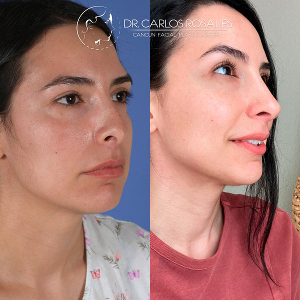 Rinoplastia secundaria