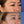 Cargar imagen en el visor de la galería, Blefaroplastia superior