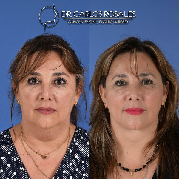 <tc>Deepplane facelift with deep necklift</tc>