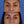 Cargar imagen en el visor de la galería, Blefaroplastia inferior