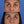 Cargar imagen en el visor de la galería, Blefaroplastia inferior