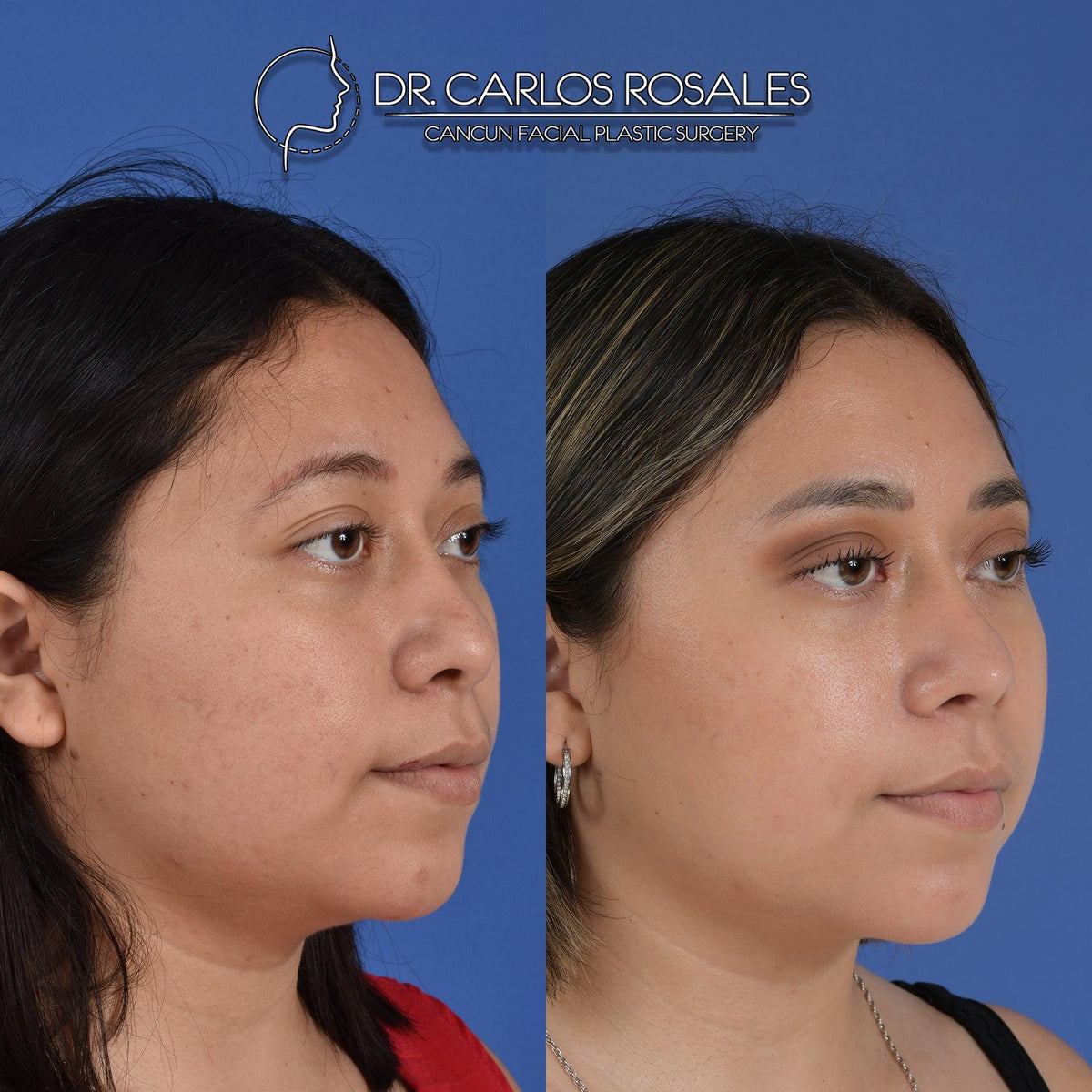 Cirugía estética facial  Plastic surgery, Rhinoplasty, Cosmetic solution
