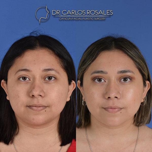 Rinoplastia secundaria