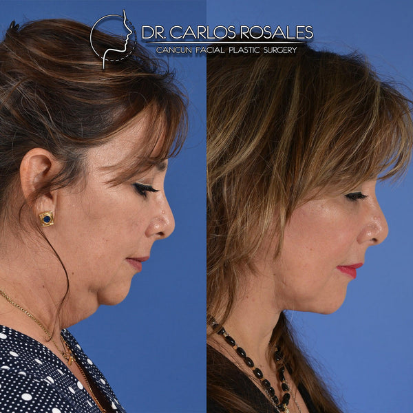 Face and neck lift