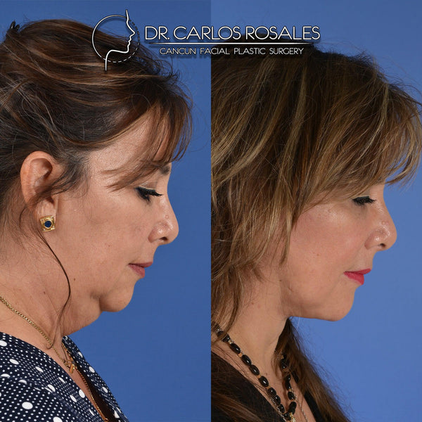 <tc>Deepplane facelift with deep necklift</tc>
