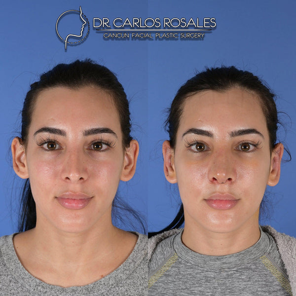 otoplasty
