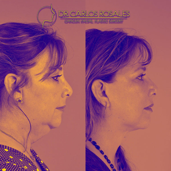 VIP face and neck lift