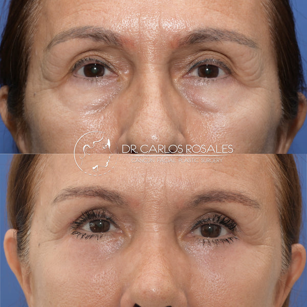 lower blepharoplasty