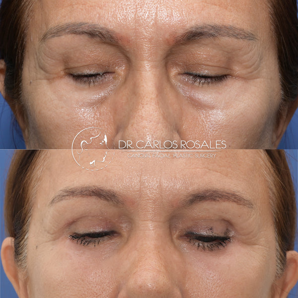 lower blepharoplasty