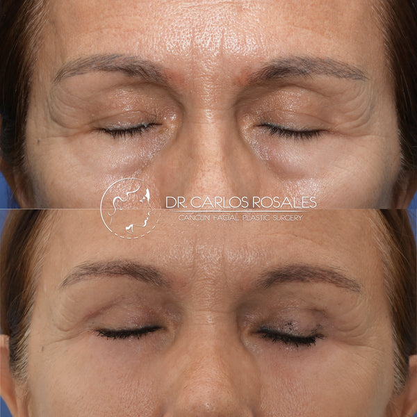 lower blepharoplasty