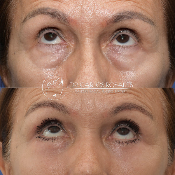 lower blepharoplasty