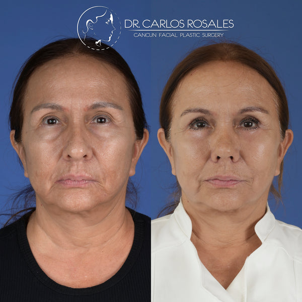 lower blepharoplasty