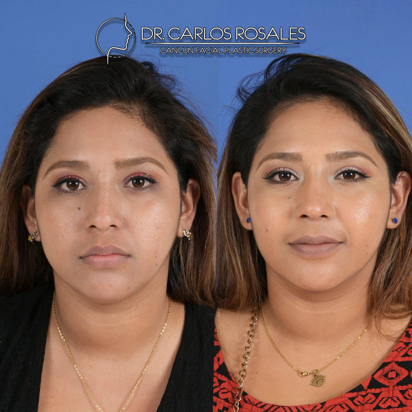 double chin liposuction