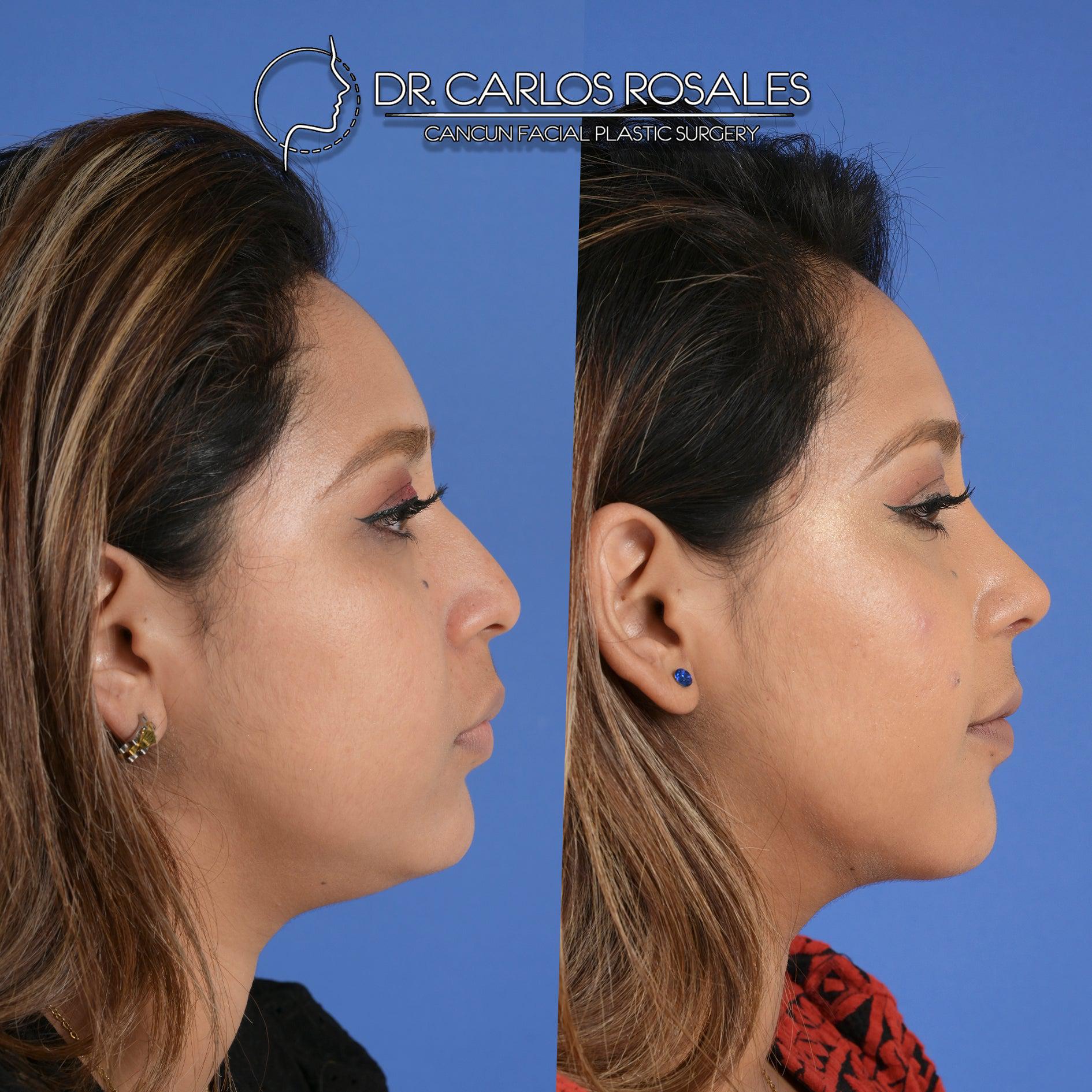 Liposucción de papada – drcarlosrosales - Main Image