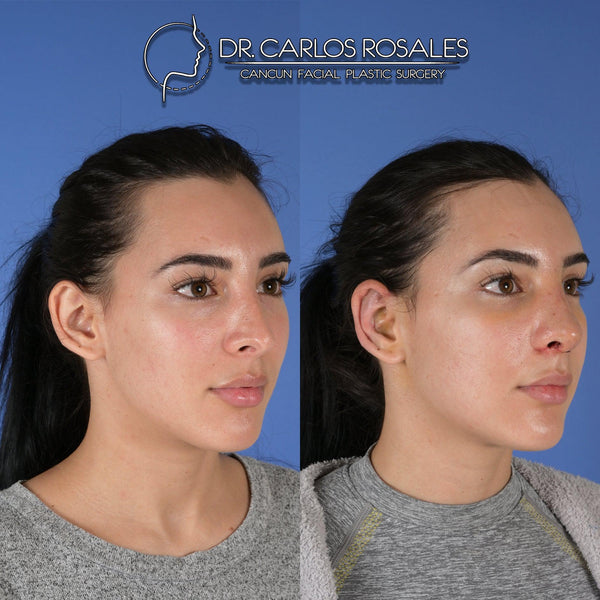 otoplasty