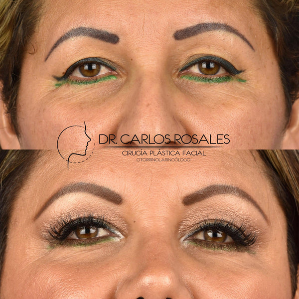 brow lift