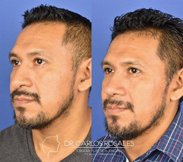 Rhinoplasty