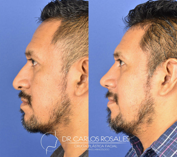 Rhinoplasty