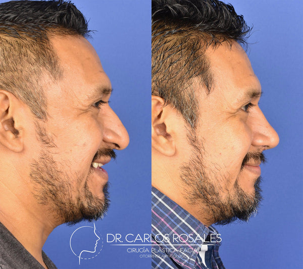 Rhinoplasty