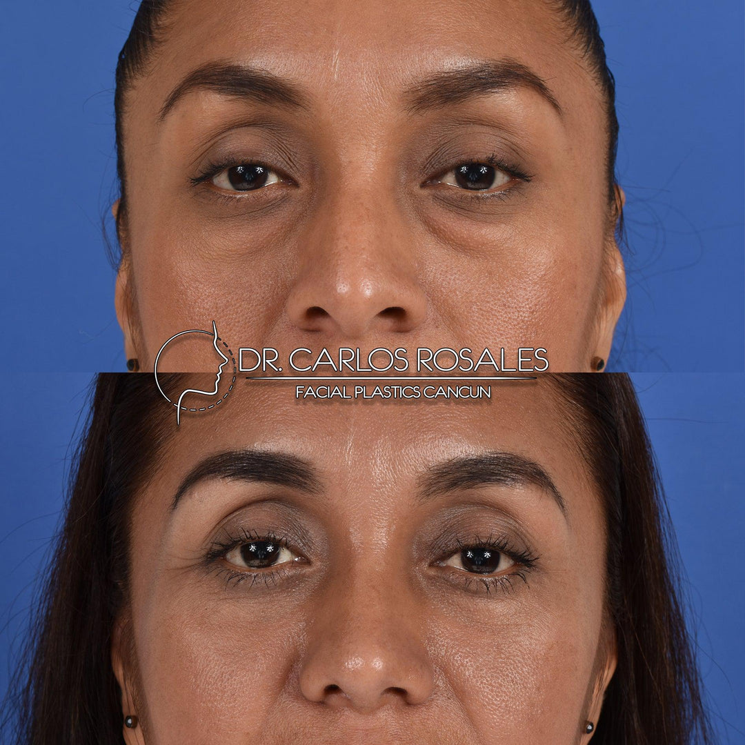 Lifting facial – drcarlosrosales